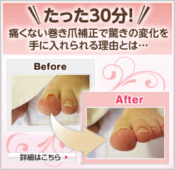 巻き爪でお悩みの方